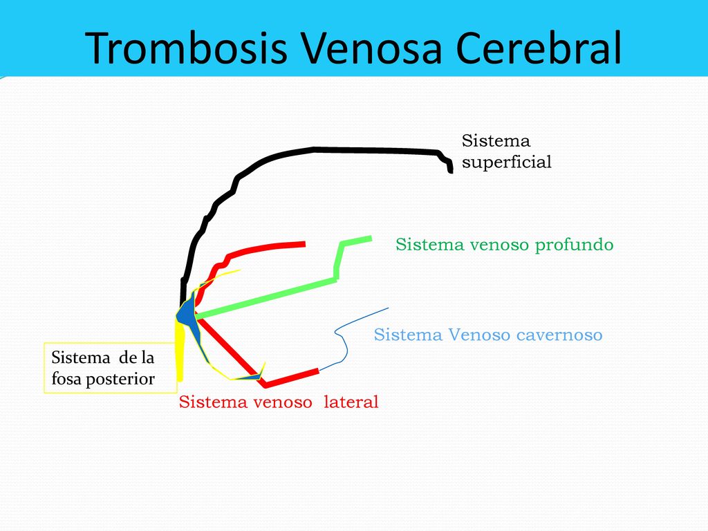 trombosis venosa cerebral definicion